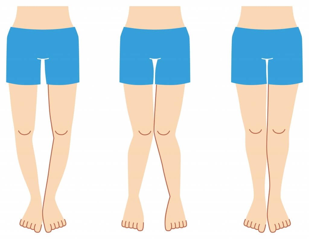 Fibromiyalji – Yumuşak Doku Romatizması