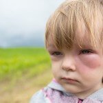 Lenfödem Nedir?