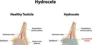 Hidrosel (Su Fıtığı) Tedavisi