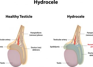 Hidrosel (Su Fıtığı) Tedavisi