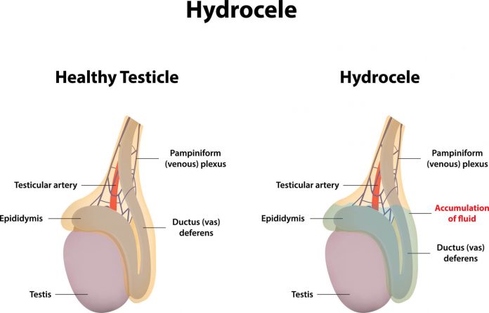 Hidrosel (Su Fıtığı) Tedavisi