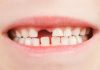 Diş Eksikliği Tedavisi