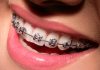 Çocuklarda Diş Çarpıklığının Sebepleri
