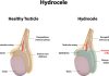 Hidrosel (Su Fıtığı) Nedir