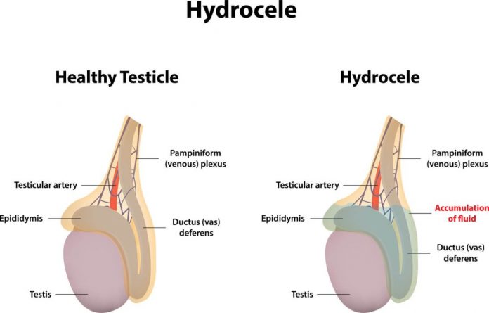 Hidrosel (Su Fıtığı) Nedir