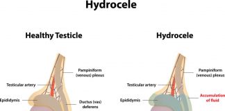 Hidroselde (Su Fıtığında) Ailelere Öneriler