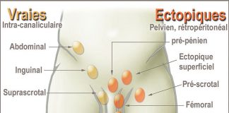 İnmemiş Testis Nedir