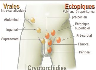 İnmemiş Testis Nedir