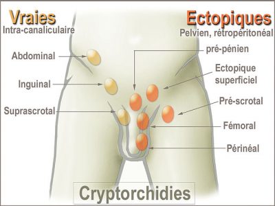 İnmemiş Testis Nedir