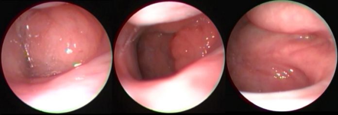 Çocuklarda Endoskopik Geniz Eti Muayenesi Doktor Amcam