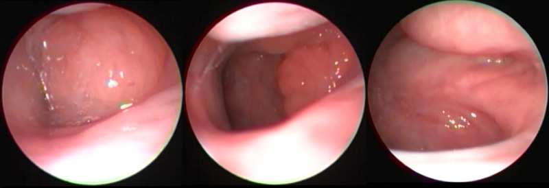 Çocuklarda Endoskopik Geniz Eti Muayenesi Doktor Amcam