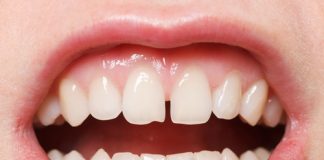 Diş Çekim Boşluğu Nasıl Tedavi Edilir