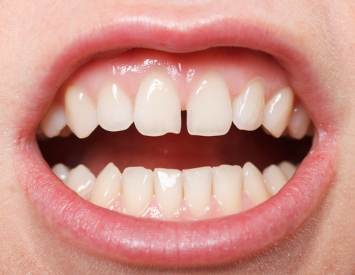 Diş Çekim Boşluğu Nasıl Tedavi Edilir