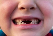 Diş Eti Kanamasının Nedenleri