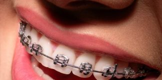 Diş Çarpıklığında Tedavi Yöntemleri