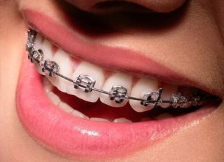 Dişlerin Telle Düzeltilmesi (Ortodonti)