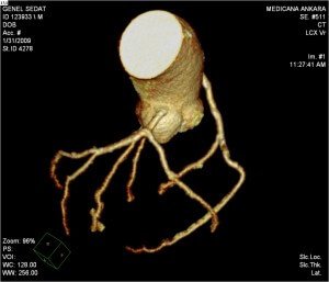 3 boyutlu BT koroner anjiyografi