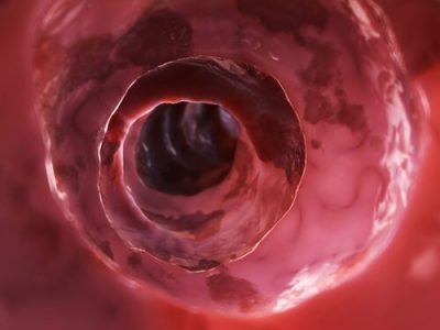 Crohn Hastalığı