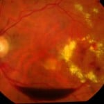 göz – diyabetik retinopaitde kanama