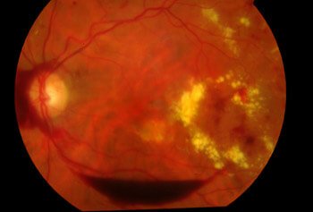göz - diyabetik retinopaitde kanama