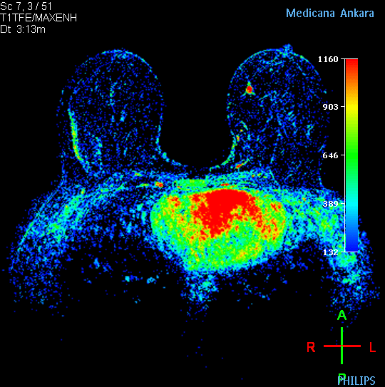 MR-Mamografi 2
